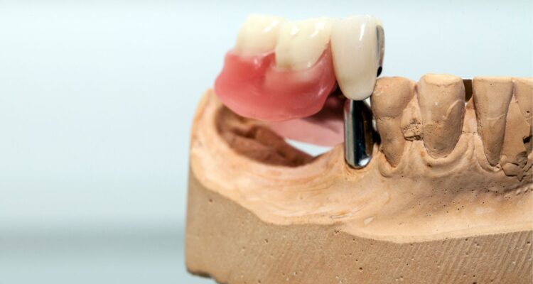 Dientes perdidos