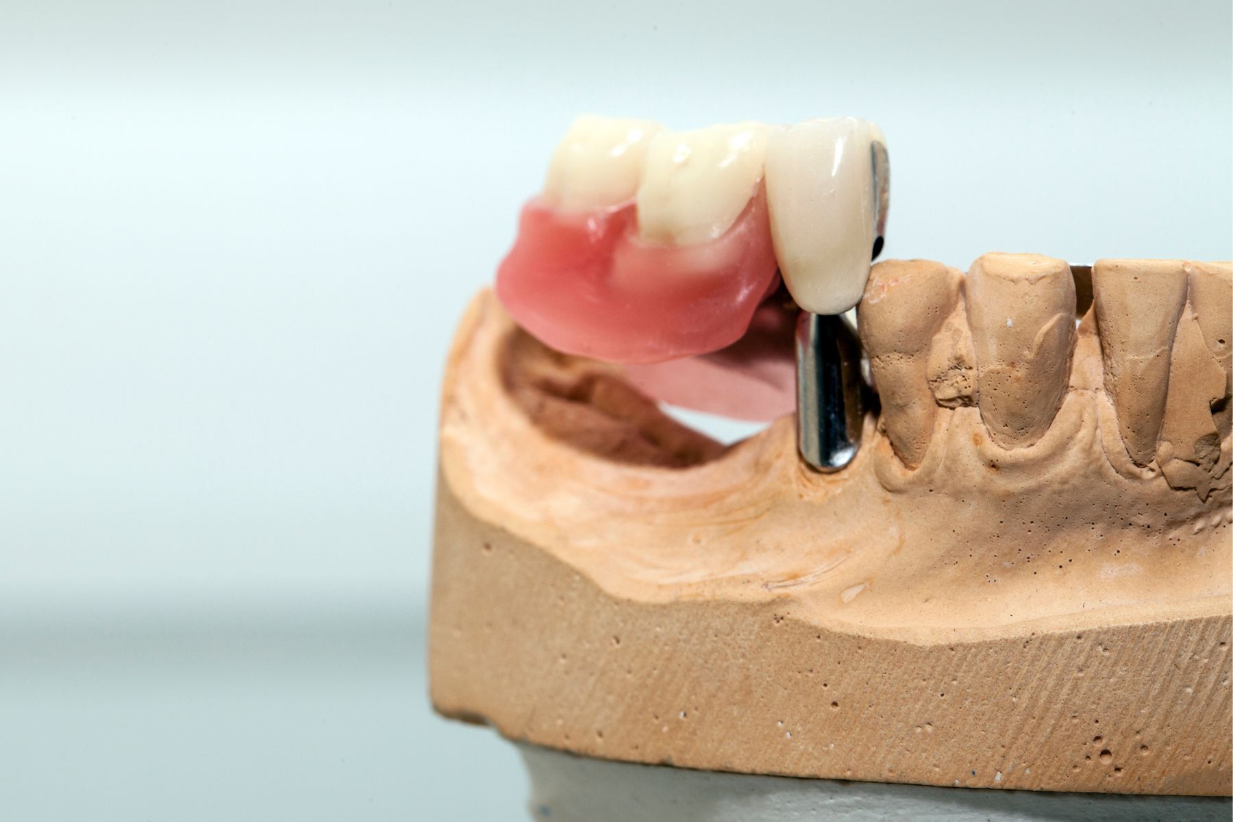 Dientes perdidos