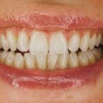 Dientes amarillos