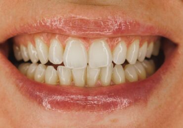 Dientes amarillos