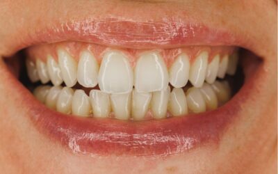 Dientes amarillos