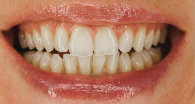 Dientes amarillos