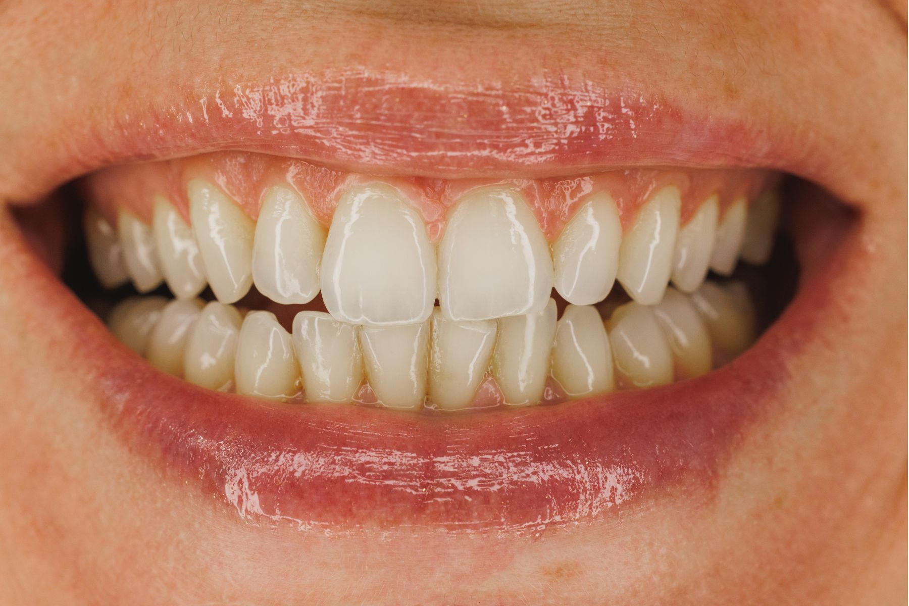Dientes amarillos